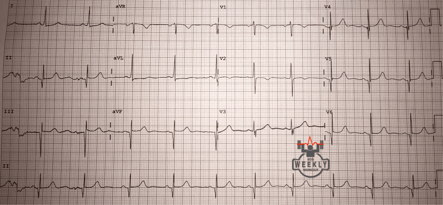 Presenting ECG — Differential Diagnoses: life threatening causes of syncope
