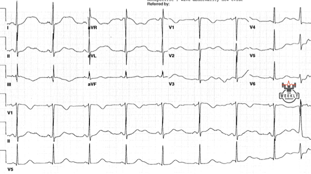Presenting ECG — ECG Basics & Fundamentals: can torsades cause seizures?