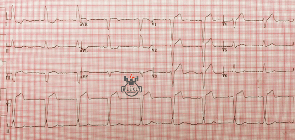 Presenting ECG — Literature Review: appropriate vs inappropriate concordance in LBBB