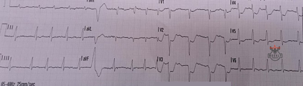 Presenting ECG — STAT ECG Diagnoses: the most commonly missed STEMI does not have ST segment elevation
