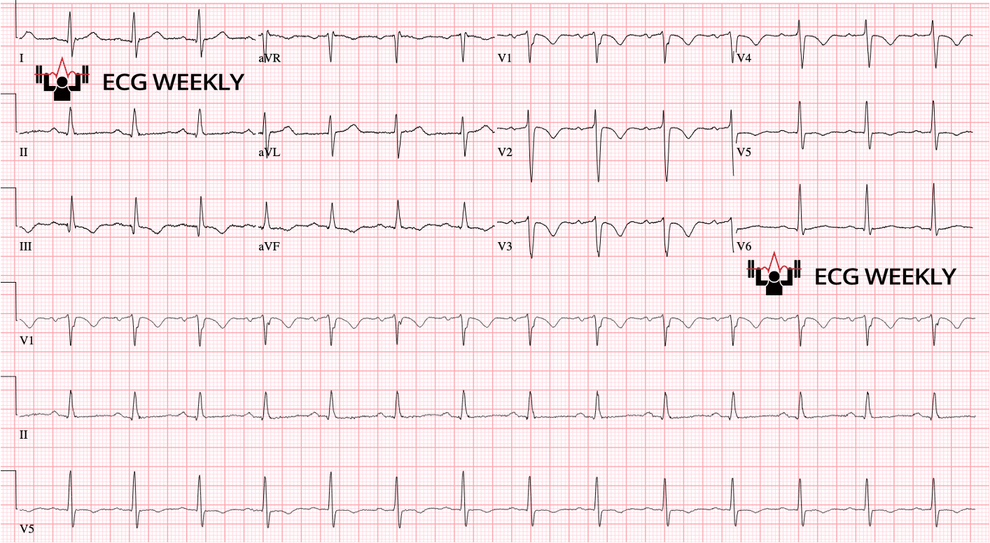 Presenting ECG — Recent UMMC Cases