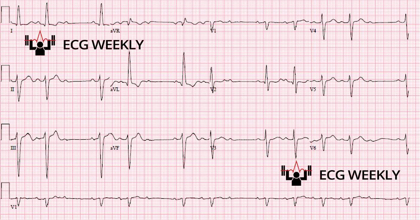 Presenting ECG — Key Points to Note About Mobitz I & Mobitz II