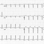ECGWeekly Case 4
