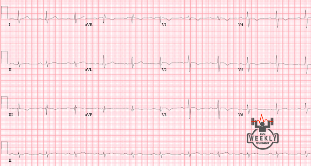 pe ecg findings