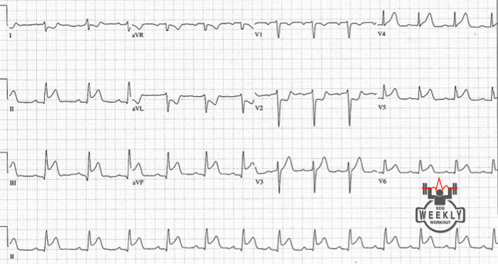 Ecg analysis. Ecg28.