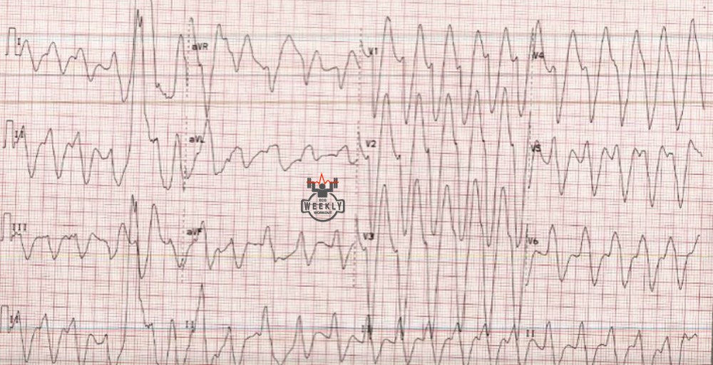 Rightward Axis Ecg Weekly