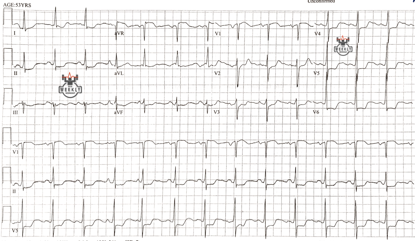 Aortic Dissection ECG Weekly