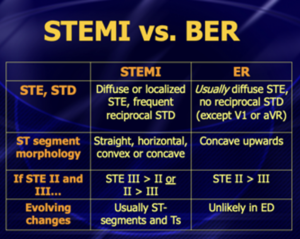 Terminal QRS Distortion ECG Weekly