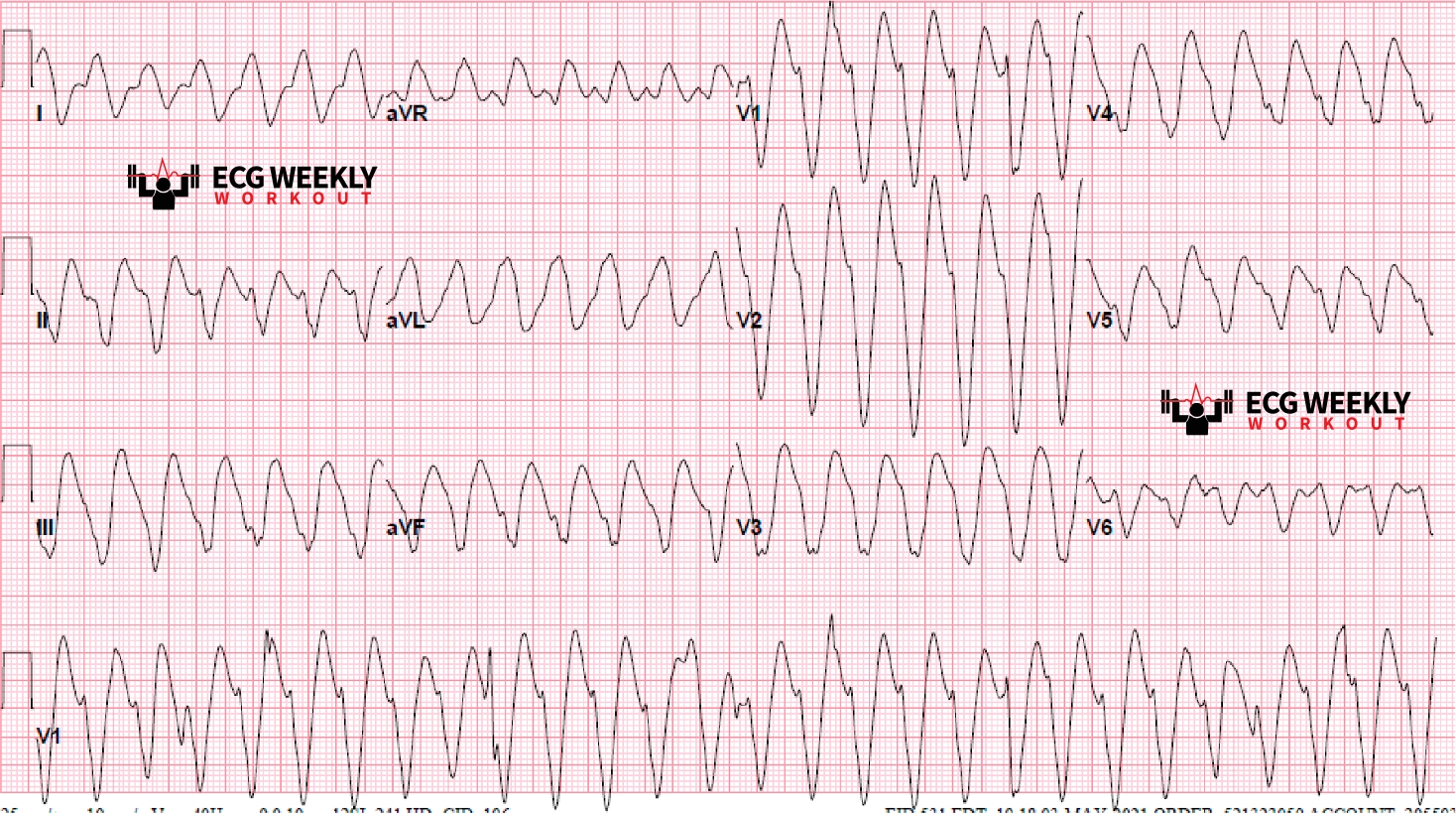 ecg 23