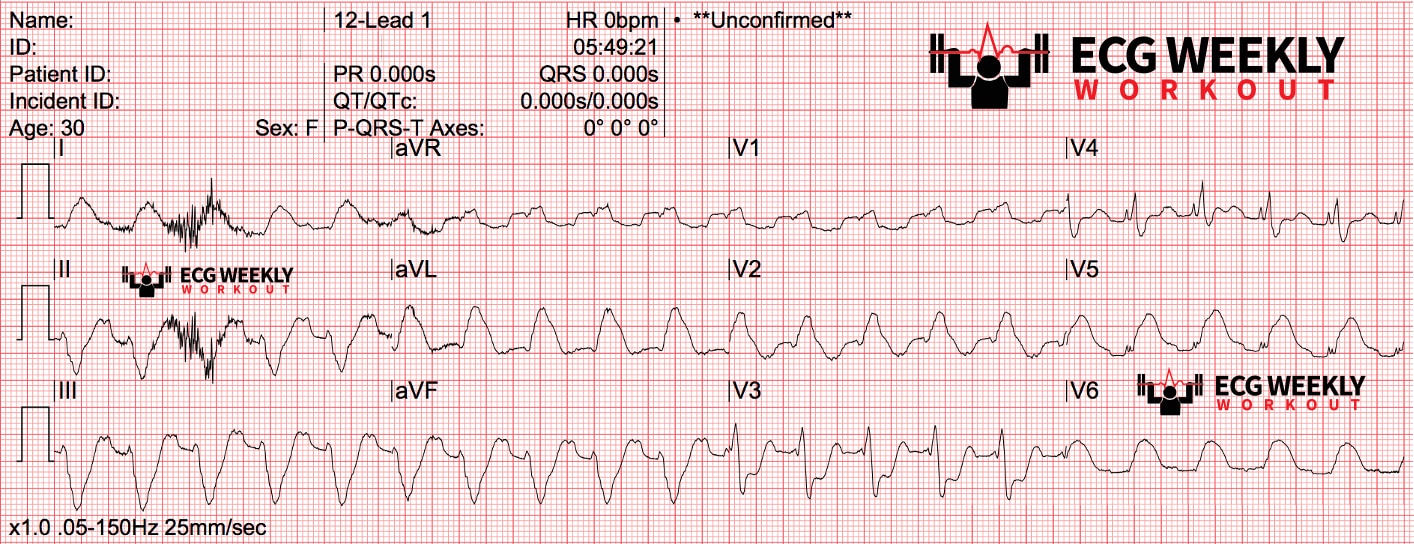 Amal Mattu’s ECG Case of the Week - December 27, 2021.