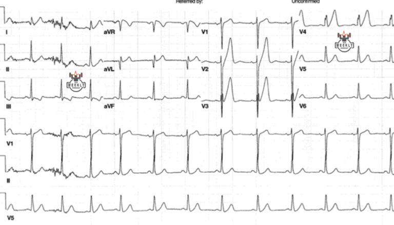 Literature Review: 2018 STEMI & STEMI equivalent guideline updates ...
