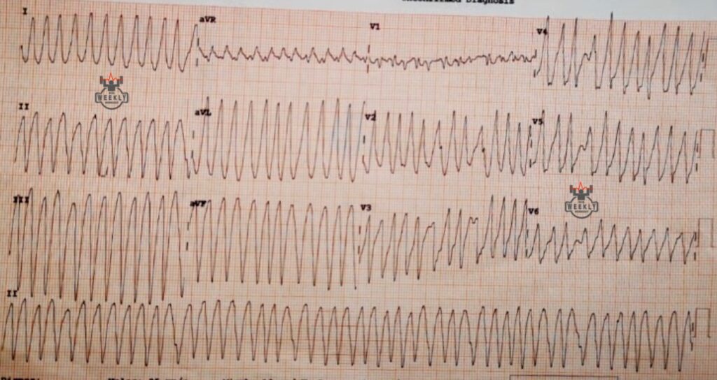 Wide Complex Tachycardias: when administering the wrong medication can ...