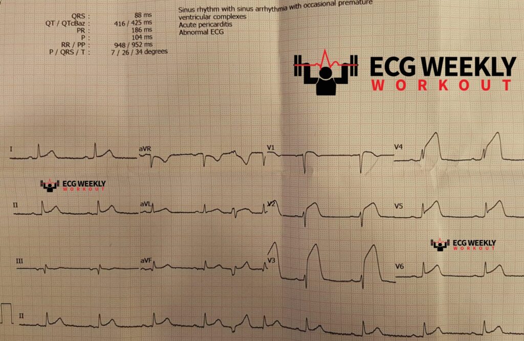 Bifascicular blocks, trifascicular blocks, electrocardiographic