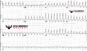 Wide Complex Tachycardias: can ECG algorithms safely rule out ...