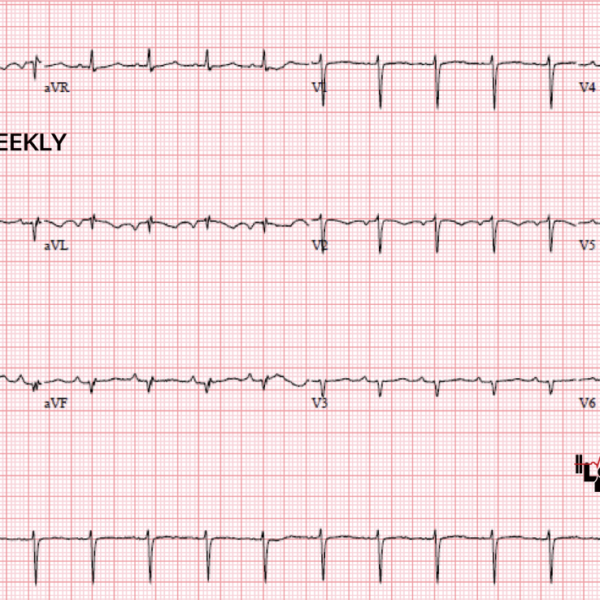 extreme axis deviation ECG Weekly