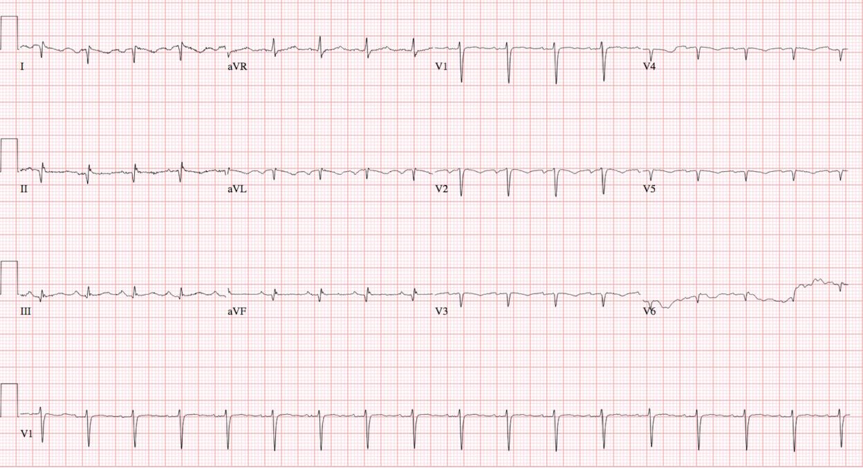 ECG6 ECG6