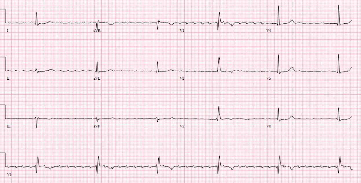 ECG7 ECG7