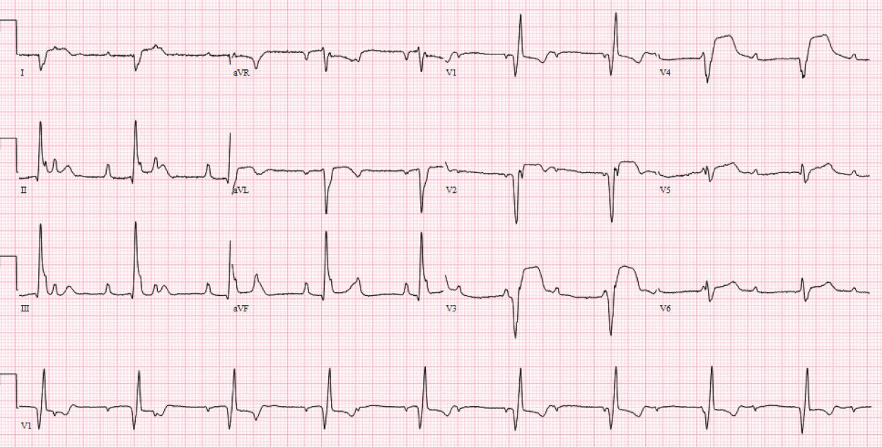 ECG8 ECG8