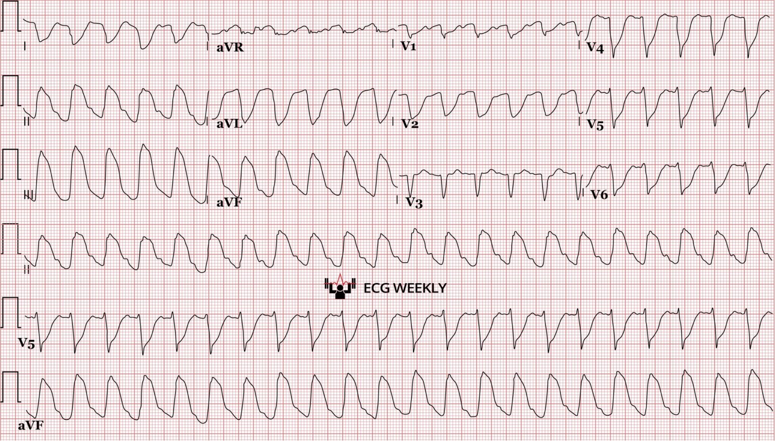 Not All Wide Complex Tachycardias Are What They Seem – ECG Weekly